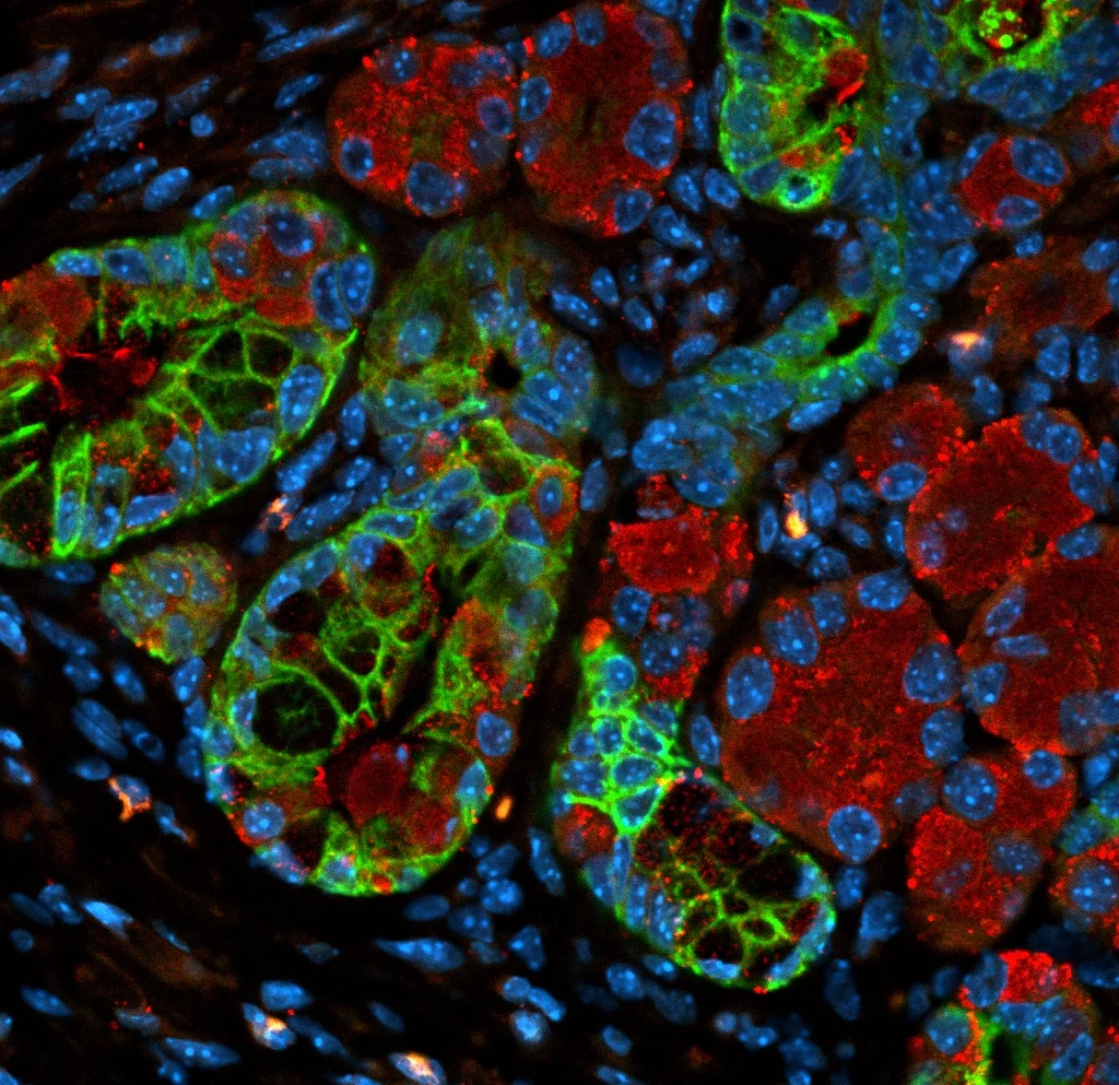 Verastem's KRAS Inhibitor Offers New Hope in Pancreatic Cancer Treatment